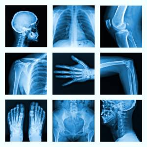 arthrose