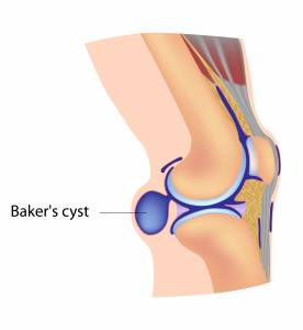 kyste_baker