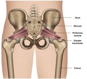 Syndrome du Piriforme